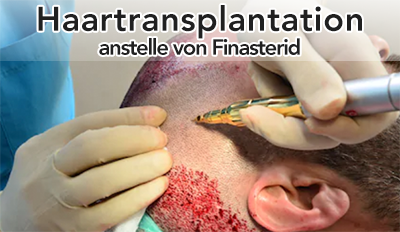 Haartransplantation-anstelle-finasterid